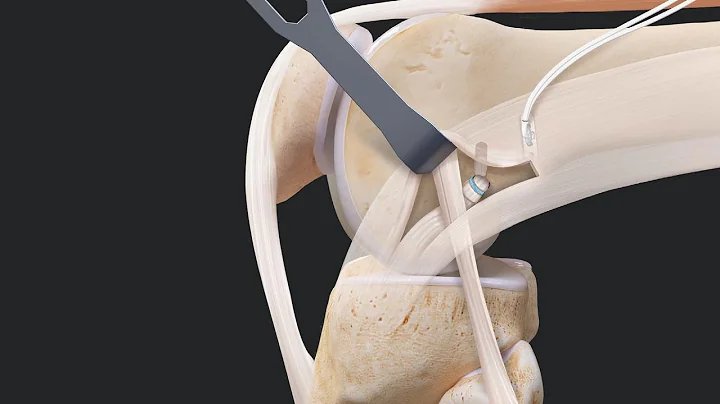 ACL Supplemental Treatment Options FAQs ACLTear.com