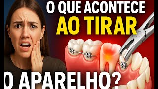 Me dê 8 minutos e explico sobre CONTENÇÃO DO APARELHO  ORTODÔNTICO