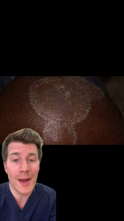 Doctor explains RINGWORM in under 60 seconds! #shorts #health #doctor #ringworm