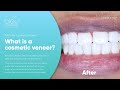 [Bleu Dentistry] Case Study: What is a Cosmetic veneer? | Emergency Dentist in Dallas TX 75219