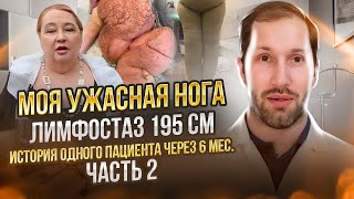 МОЯ УЖАСНАЯ НОГА: ЛИМФОСТАЗ 195 см - история одного пациента - часть 2 - отдаленные результаты