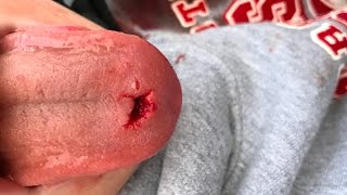 Insane BMX 9 year old bites a hole through his tounge off of ramp