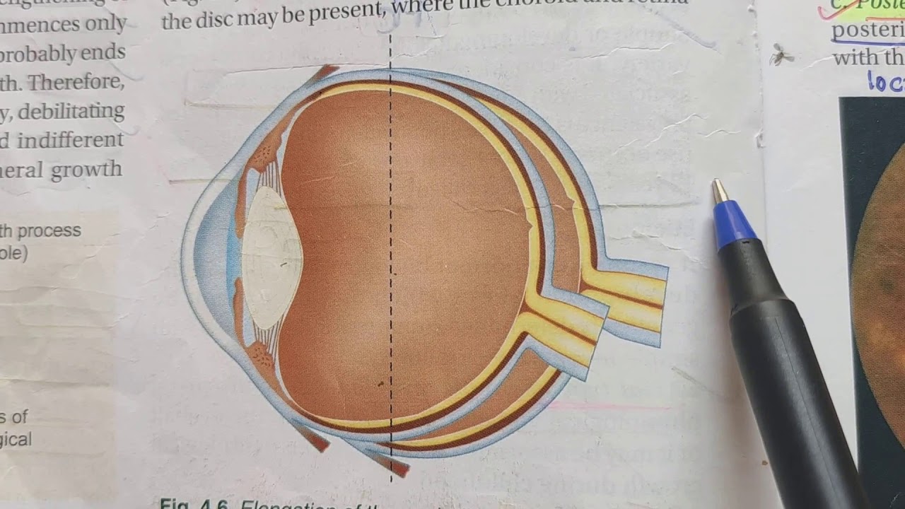 Myopia Refractive Error Theory Exam Notes AK Khurana YouTube Myopia refractive error theory exam notes ak khurana youtube