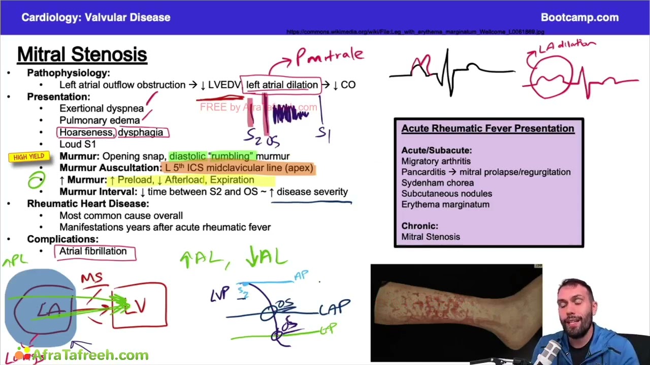 Mitral stenosis || Valvular disease || Cardiology 