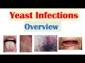 Candidal (Yeast) Infections Overview | Oral Thrush, Vaginal, Intertrigo, Esophageal Candidiasis