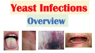 Candidal (Yeast) Infections Overview | Oral Thrush, Vaginal, Intertrigo, Esophageal Candidiasis