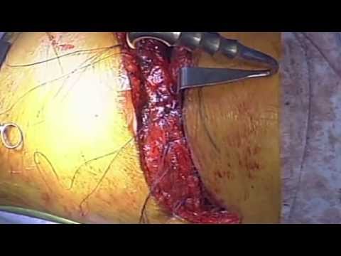 Video-atlas of extrapleural pneumonectomy