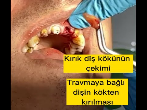 Travmaya bağlı dişin kökten kırılması, diş çekimi, canlı kayıt // Tooth extraction,  dental asmr