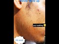 Minoxidil beard journey in just 3 mounts  beard growth