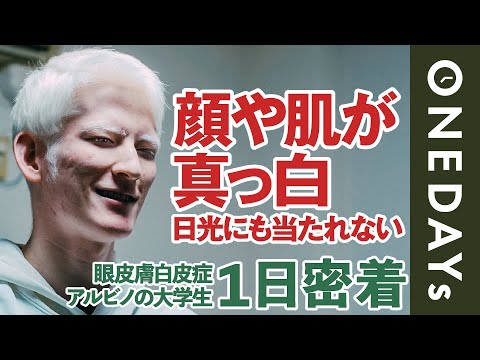 【生まれつき真っ白】アルビノの男性に1日密着してみた