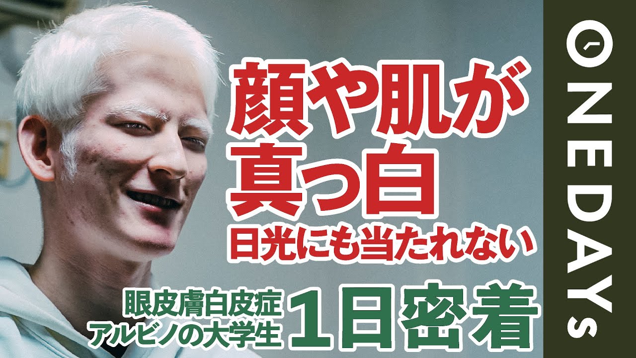 【生まれつき真っ白】アルビノの男性に1日密着してみた