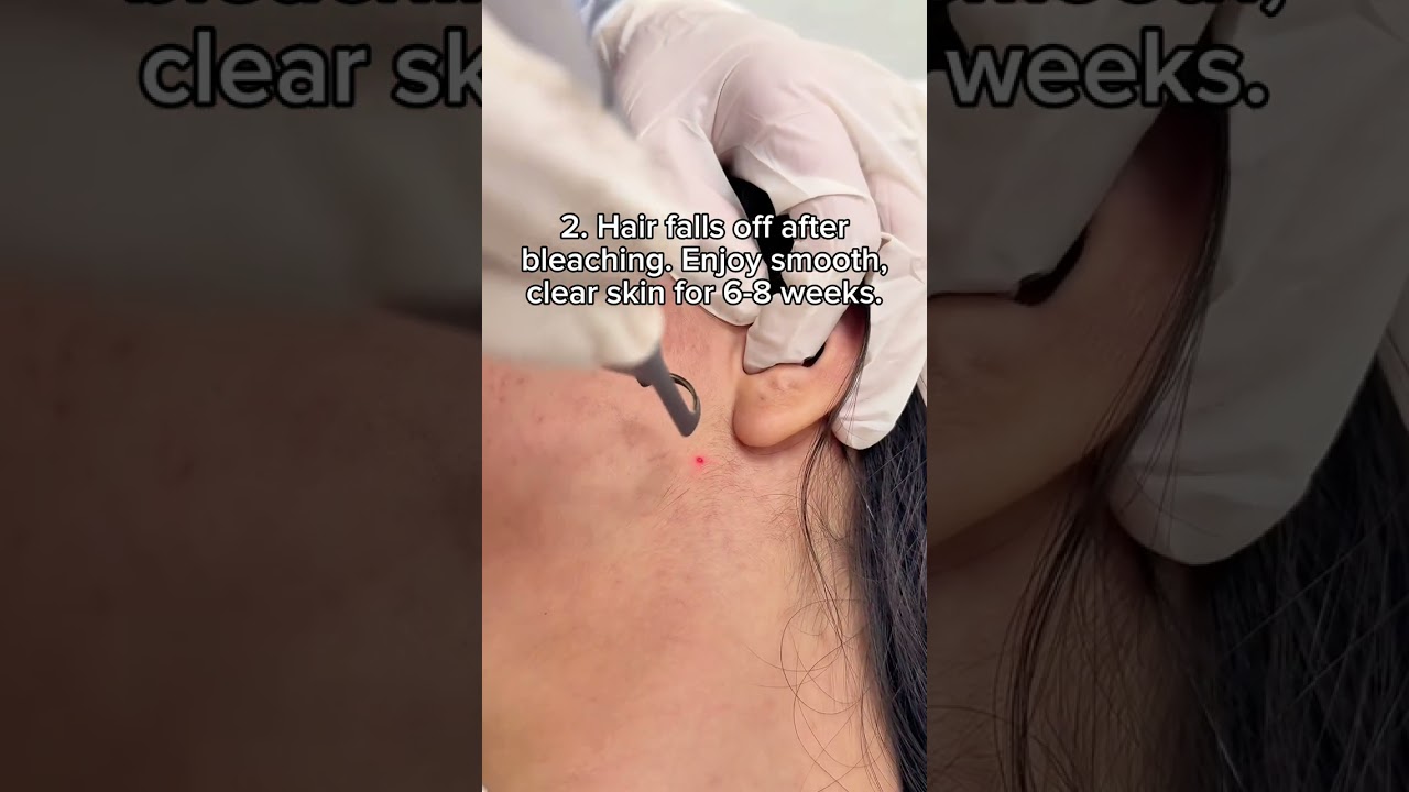 4 reasons you’ll regret opting for Laser Hair Bleaching. 👀🤭