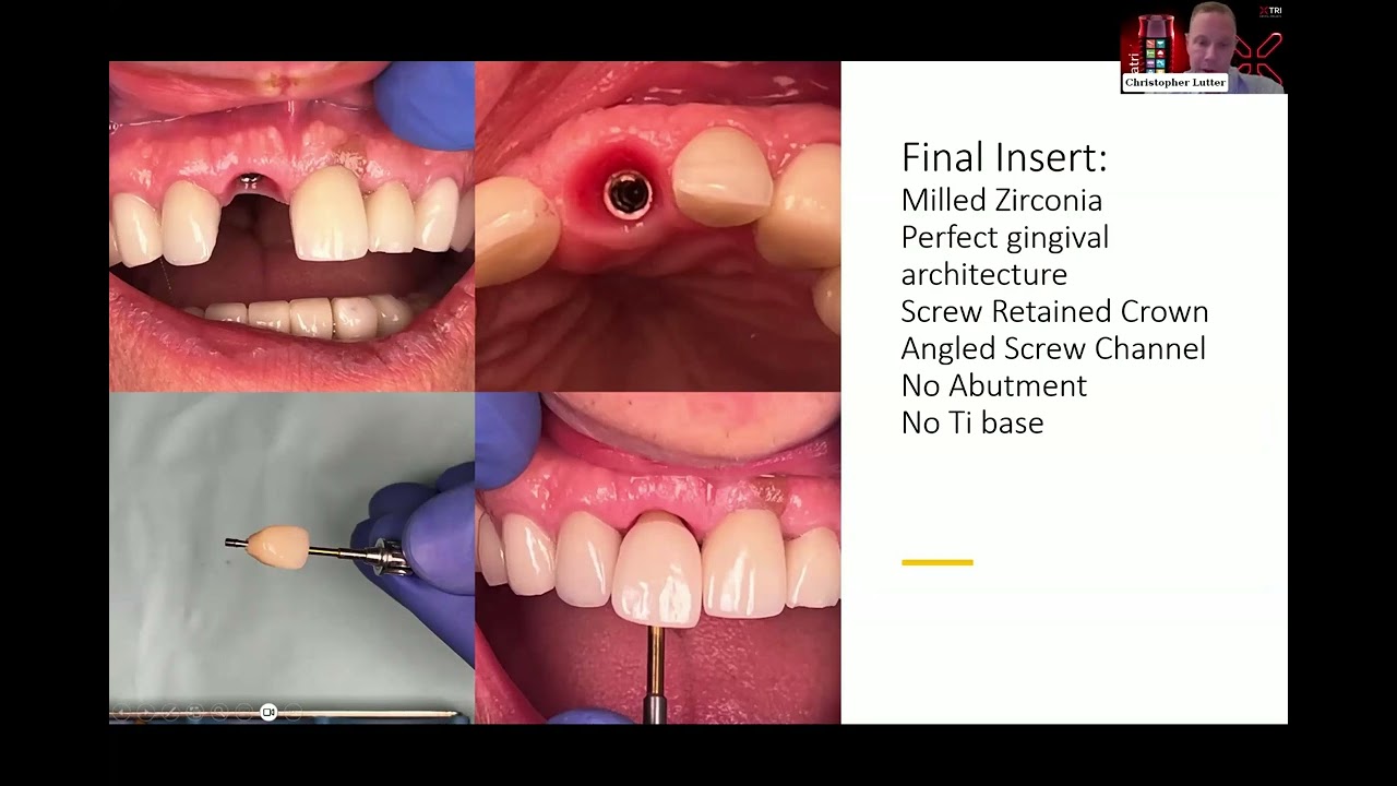 Advancing Full Mouth Restoration: The matrix® 3 on 6™ No-Abutment Technique | Randy Roberts | TRI®