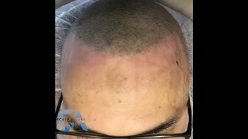 Scalp Allure Scalp micro pigmentation natural hairline results