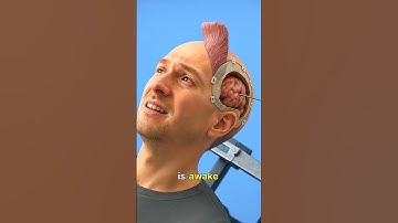Awake Brain Surgery 🤕 (3D Animation)