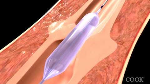 Hercules® 3 Stage Balloon Dilator Animation