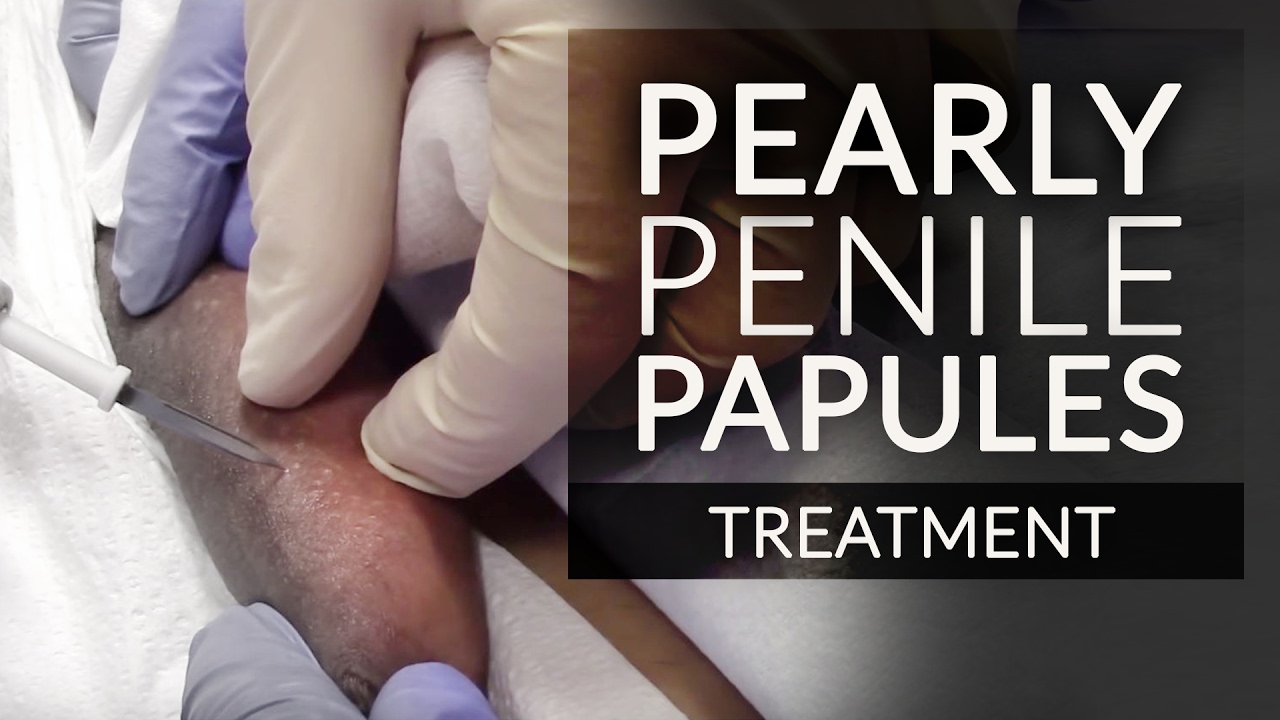 Shaft ppp on Penile Bumps