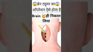 Brain Toumer operation 😱| #1ontranding #factshortsvideos #braintumors #braintumorsurvivor #brain 😱