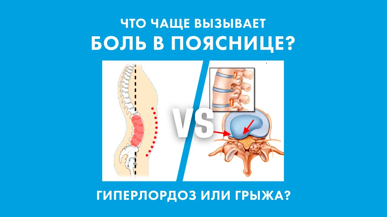 Боль в пояснице: всегда ли виновата грыжа? а может из-за гиперлордоза ...