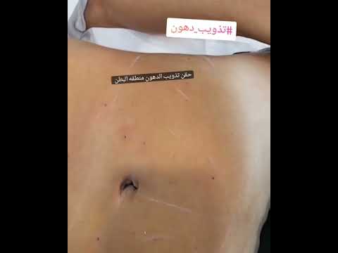 تذويب دهون منطقه البطن