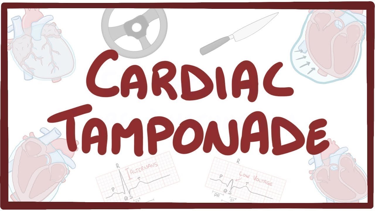 Cardiac tamponade - causes, symptoms, diagnosis, treatment, pathology ...