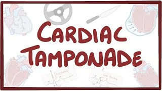 Cardiac tamponade - causes, symptoms, diagnosis, treatment, pathology