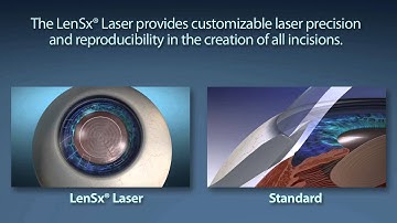 LENSX® LASER:  THE COMPLETE ANTERIOR SEGMENT CATARACT SURGICAL EXPERIENCE