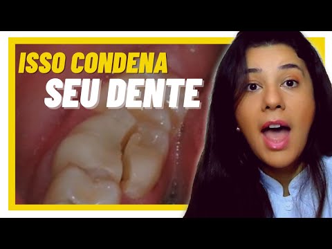 Como aliviar dor de dente quebrado? Seu dente pode ter a Síndrome do Dente Rachado!