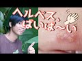 口唇ヘルペスを薬なしで１日で治す方法【簡単】how to care Herpes simplex virus
