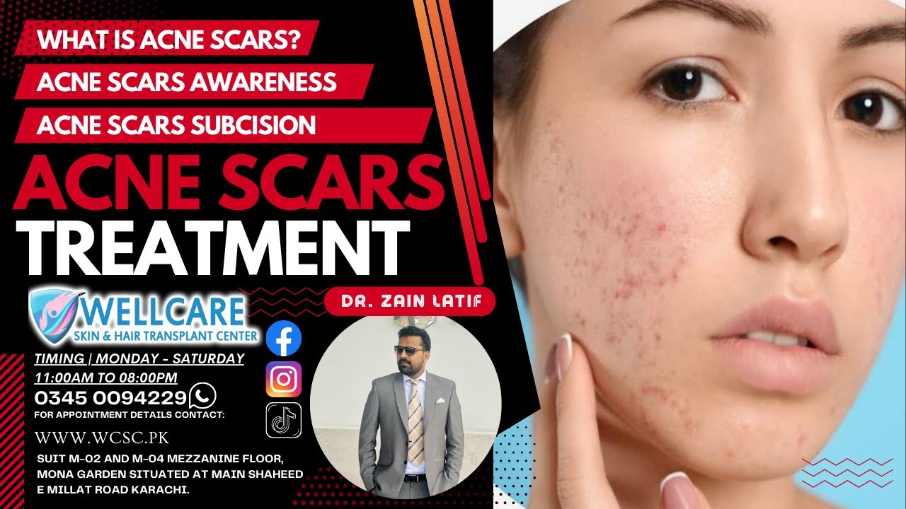 What is Acne Scar Acne Scar Subcision Treatment Acne Scar Awareness