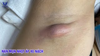 Nặn mụn nhọt áp xe vùng nách - Cam kết hiệu quả| Mụn không tái lại.