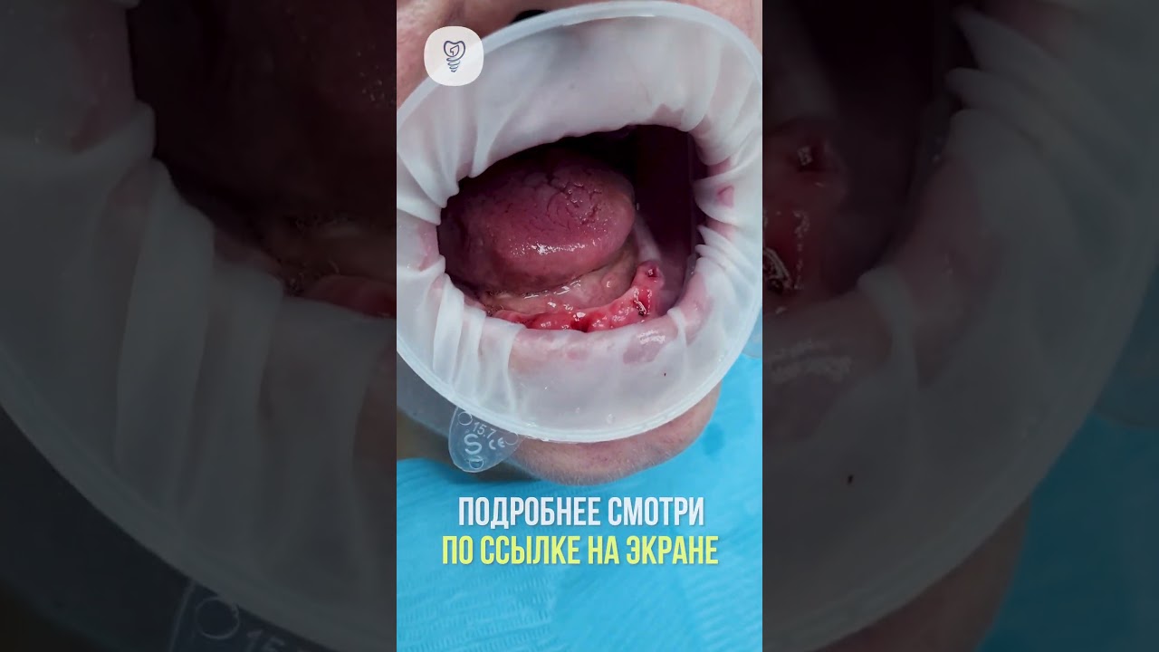 Установили 16 имплантатов и вышли из безвыходной ситуации. История пациента. Имплантация зубов.