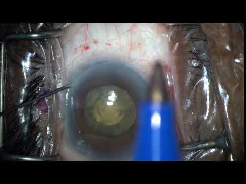 iTrack™ Procedural Steps: Paracentesis / OS Eye