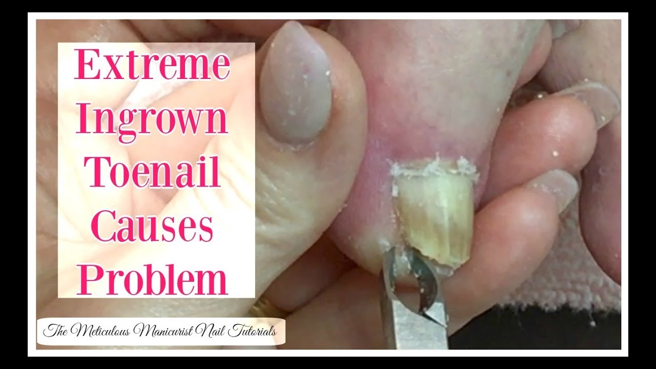 Extreme Ingrown Toenail Causes Problem That Needs To Be Removed