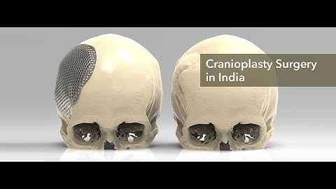 Cranioplasty CPT code - simplify medical coding