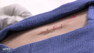 Staple Removal