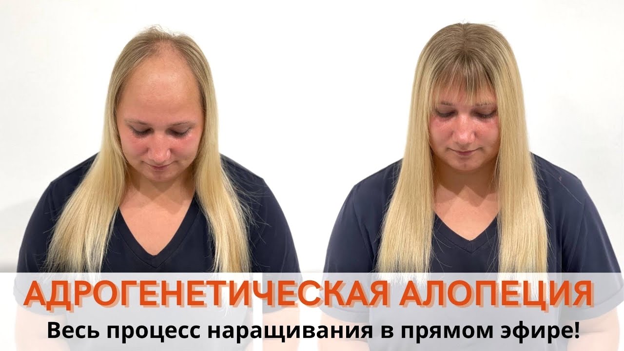 Решение проблемы при андрогенетической алопеции! - YouTube