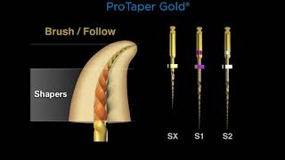 Canal Preparation with ProTaper Gold®
