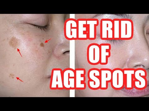 How to Get Rid of Age Spots On Face + Hands + Legs Naturally (HOME REMEDIES) - Age Spot Removal!