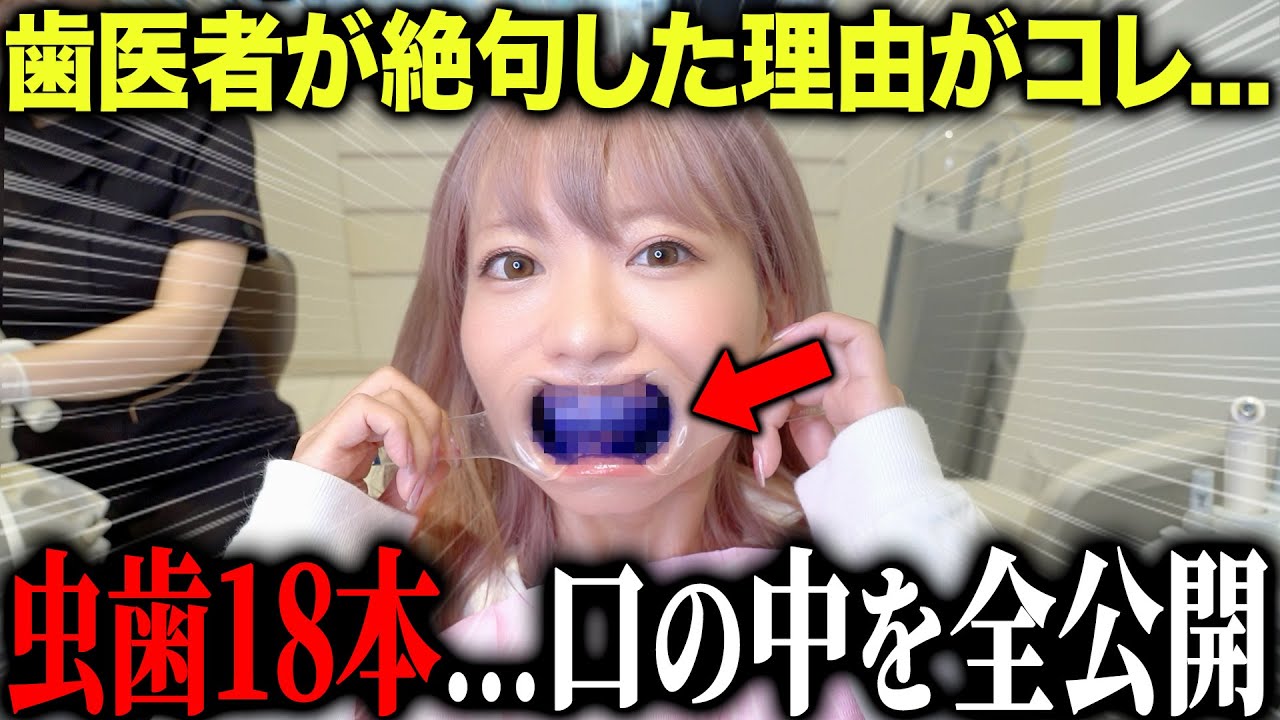虫歯18本の美女の口の中を大公開…歯医者も驚愕したその理由がこちら。