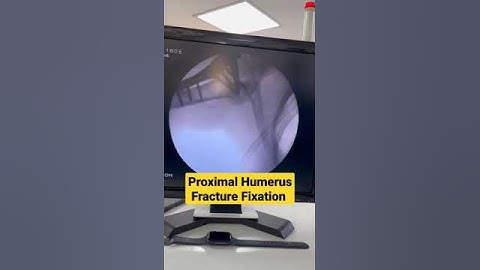 Proximal Humerus Fracture Fixation ..Dr Sai Chandra..Knee N Shoulder Surgeon in Hyderabad