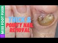 Thick and Pointy Nail Removal |  Miss Foot Fixer |  Marion Yau
