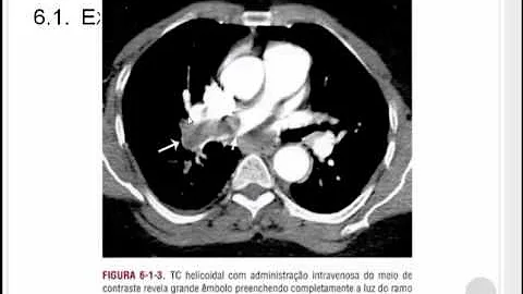 Como identificar um TEP na tomografia?