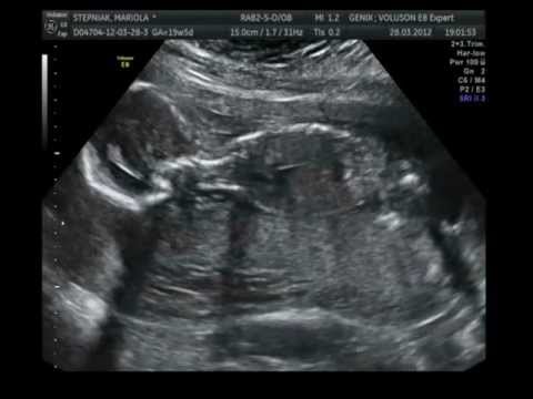 Ultrasound 2D 3D/4D 20 week baby boy-Danny - YouTube