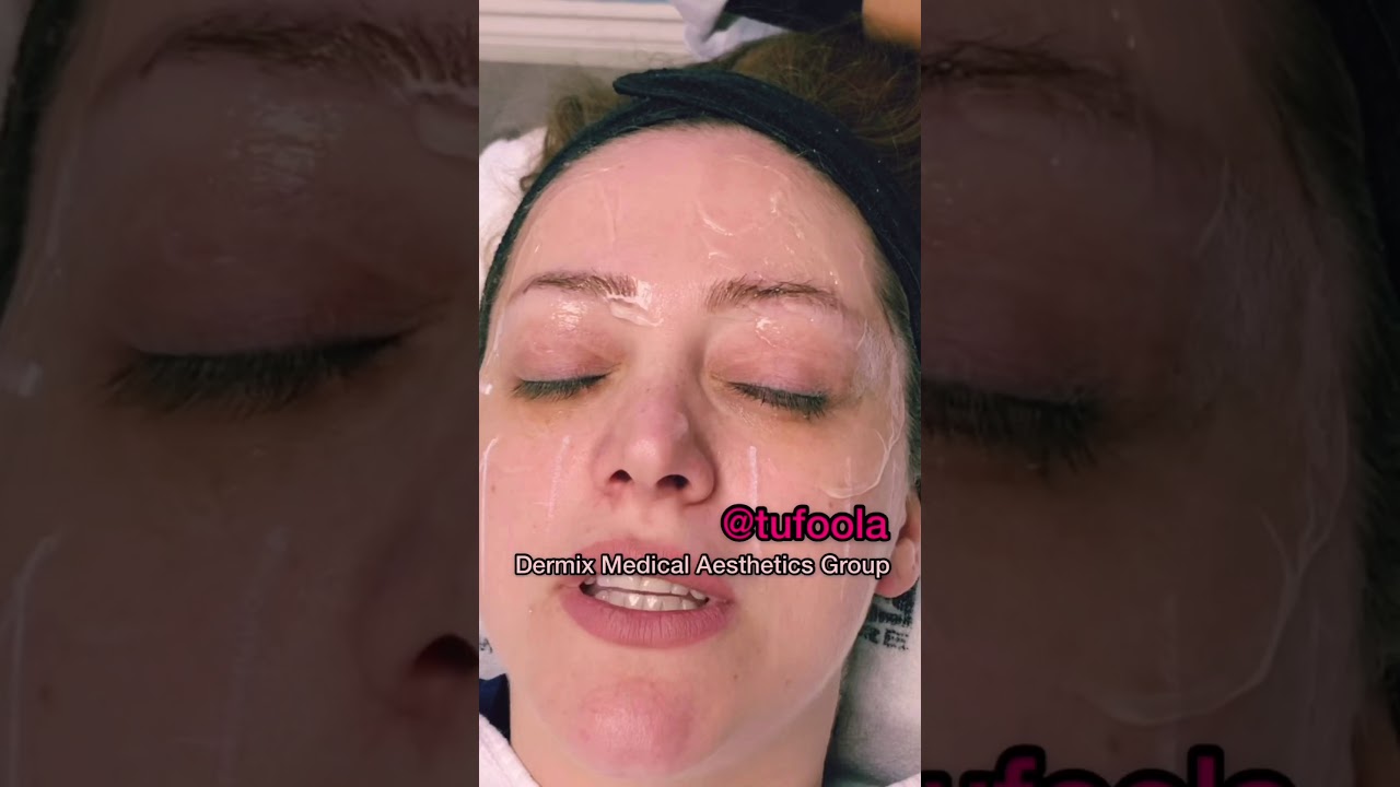 تجربتي مع جهاز الالثيرا الاميركي لعلاج التجاعيد 👍🏼