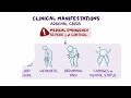 Adrenal insufficiency (Year of the Zebra)