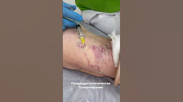 Склеротерапия сосудистой сетки. Удаление сосудистых звёздочек. Флеболог Москва