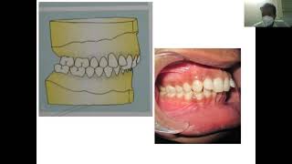 Angles's classification of malocclusion