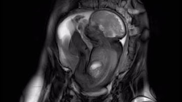 MRI Fetus 32 weeks