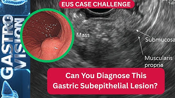 EUS Challenge: Mixed Echogenic Subepithelial Gastric Mass #Endoscopic ultrasound